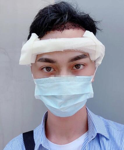 张鹏程医生植发案例