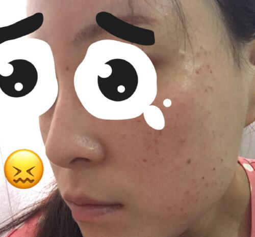 祛黄褐斑果图分享