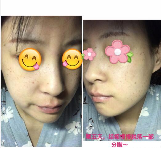 祛黄褐斑果图分享