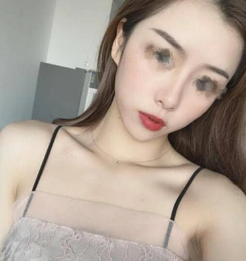 苏州维多利亚美容医院隆鼻案例分享