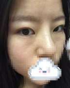 文辉才双眼皮价格贵不贵？来看真人做双眼皮实际果+收费明细表