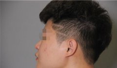 男人隆鼻有吗？来看本人做隆鼻过程实拍图！果不错哦