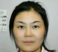 开眼尾果图曝光！本人做开眼角手术全过程记录贴！