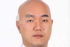 武汉协和王巍双眼皮技术好不好？附真人做双眼皮果图哦