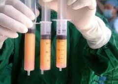全身抽脂大概要多少钱？操作原理是什么？有什么注意事项