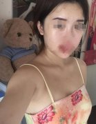 隆胸真实案例图片来袭！术后果简直不要太好！快来看