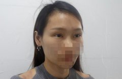 打完泪沟恢复过程图片分享！本人做填泪沟术后3个月果曝光