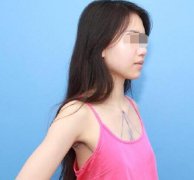 隆胸前后对比照图片分享！来看我的真实过程分享吧