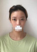 欧式双眼皮图片分享！附上我的亲身经历分享！快来看吧