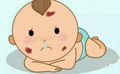 激光去胎记会留疤吗？果怎么样？快戳进来看看吧