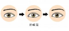 开内眼角和外眼角有什么区别？术前术后注意事项有哪些？