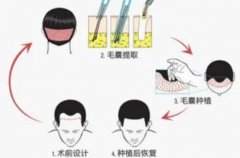 tddp植发技术成熟了吗？手术原理是怎样的？没问题性如何？