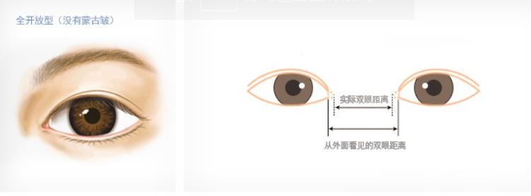 宋保强医生做双眼皮的技术好不好？医生技术优势分析+实操双眼皮案例分享！