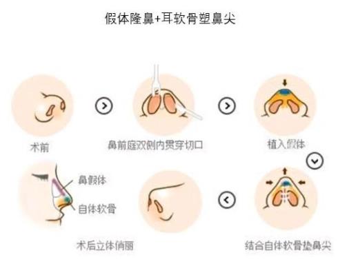 耳软骨隆鼻01.jpg