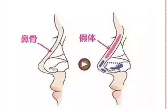 膨体隆鼻02.jpg 膨体隆鼻02.jpg
