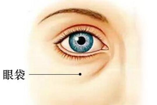 去眼袋h4.jpg