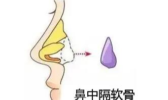 耳软骨隆鼻子大概多少费用03.jpg 耳软骨隆鼻子大概多少费用03.jpg