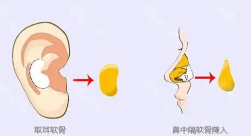 耳软骨隆鼻子大概多少费用01.jpg 耳软骨隆鼻子大概多少费用01.jpg