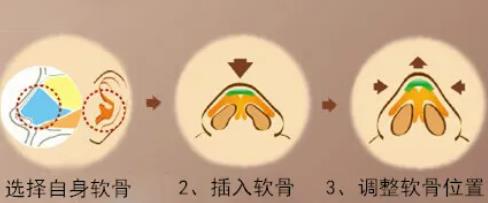 自体耳软骨隆鼻好吗?适合人群，隆鼻整形手术优缺点!
