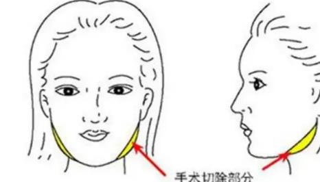 宽下颌角整形，图解分享，真人恢复过程，变化不小吧!