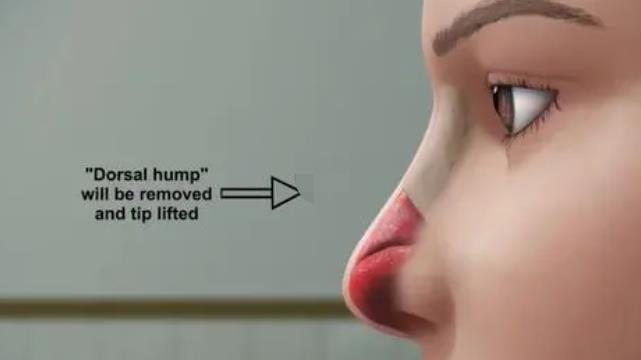 隆鼻动漫h19.jpg 隆鼻动漫h19.jpg