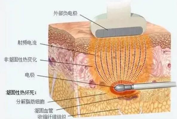基础美整形吸脂技术如何？真人做吸脂手术前后对比图分享！