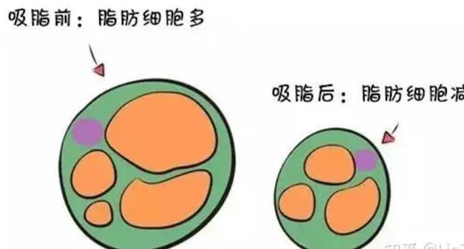 吸脂dm024.jpg 吸脂dm024.jpg