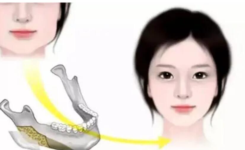 赵贵庆医生下颌角技术靠谱吗？真人案例展示：轻松拥有精致脸型！