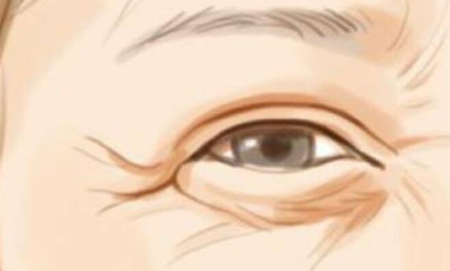 怎样去除眼下皱纹？有什么好的方法推荐吗？戳进来看！