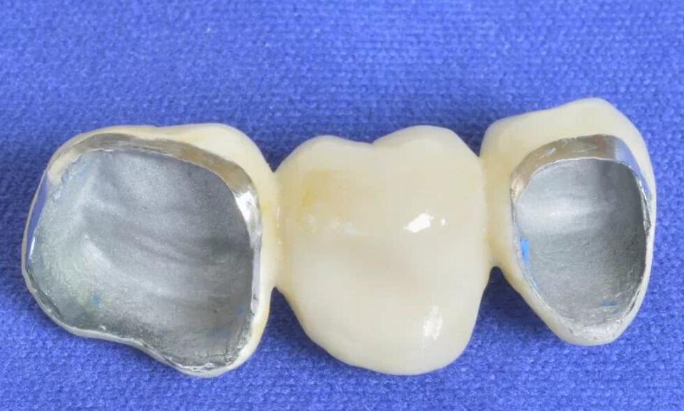 装个烤瓷牙多少钱？贵不贵？术后应该如何护理呢？