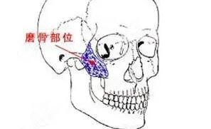 下颌角磨骨动漫.jpg 下颌角磨骨动漫.jpg