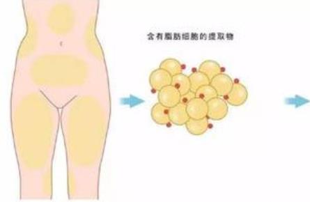 部自体脂肪填充风险大吗?做填充需要花多少钱?