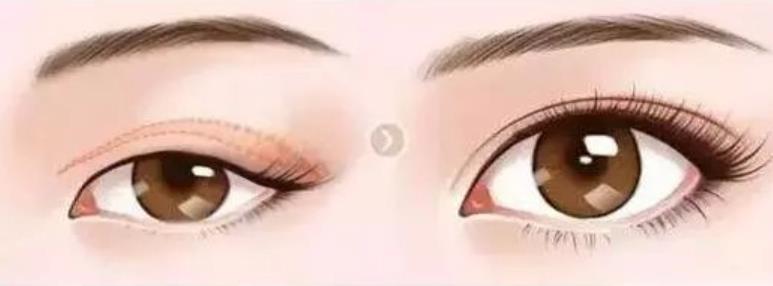 日式和埋线的区别是什么?那种果保持的长一些?费用如何