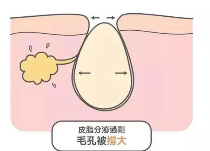 鼻子毛孔粗大03.jpg 鼻子毛孔粗大03.jpg
