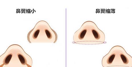 隆鼻h45.jpg 隆鼻h45.jpg