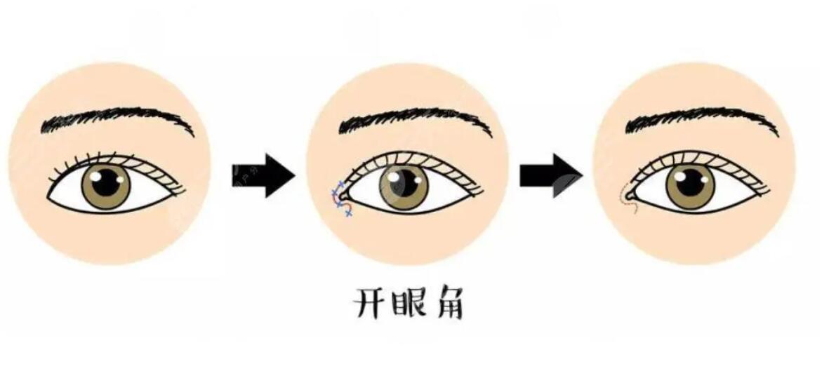 韩式开眼角整形手术术后恢复周期及注意事项盘点！快来收藏！
