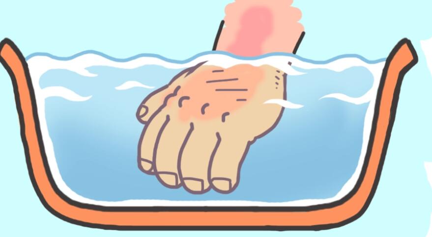 烫伤后起水泡02.jpg