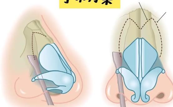 鼻骨内推04.jpg 鼻骨内推04.jpg