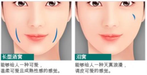 酒窝整形价格是多少?有真人做酒窝整形对比照及价格参考哦!