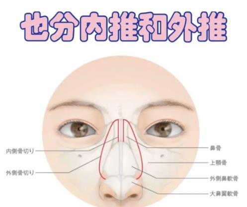 鼻骨内推05.jpg 鼻骨内推05.jpg