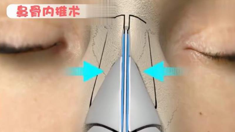 鼻骨内推前后对比照曝光|真人做鼻骨内推手术之后恢复期记录分享!