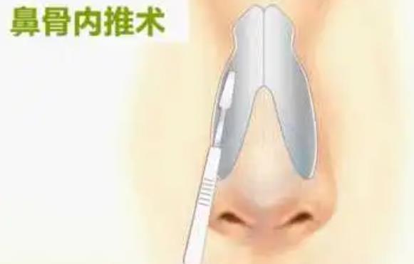 鼻骨内推03.jpg 鼻骨内推03.jpg