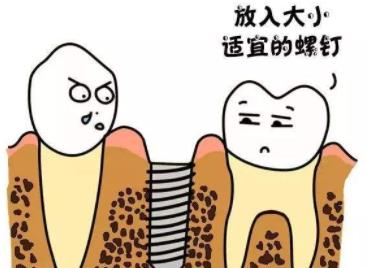 牙齿种植dm05.jpg