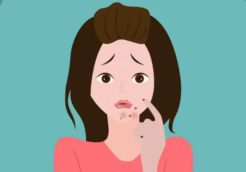 怎么去除痘印痘疤呢？你想知道的都在这里哦！