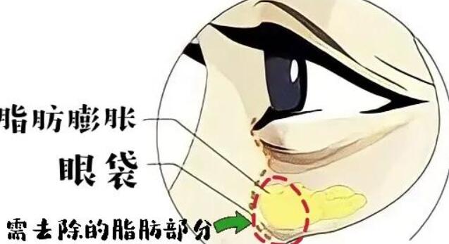 去眼袋动漫51.jpg 去眼袋动漫51.jpg
