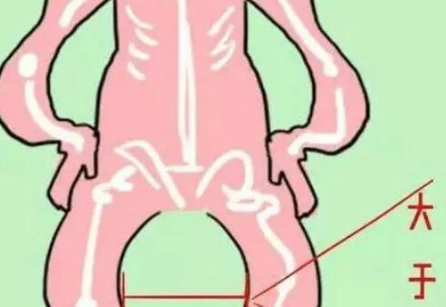 O型腿04.jpg O型腿04.jpg