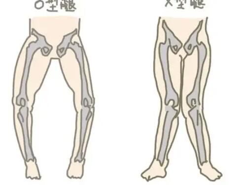 O型腿03.jpg O型腿03.jpg