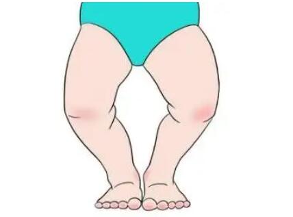 O型腿02.jpg O型腿02.jpg