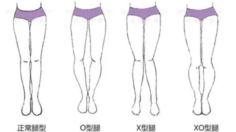 如何矫正o型腿？形成原因及矫正方法详细介绍！快来深入了解一下吧！
