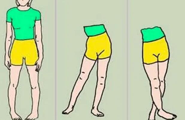 O型腿01.jpg O型腿01.jpg